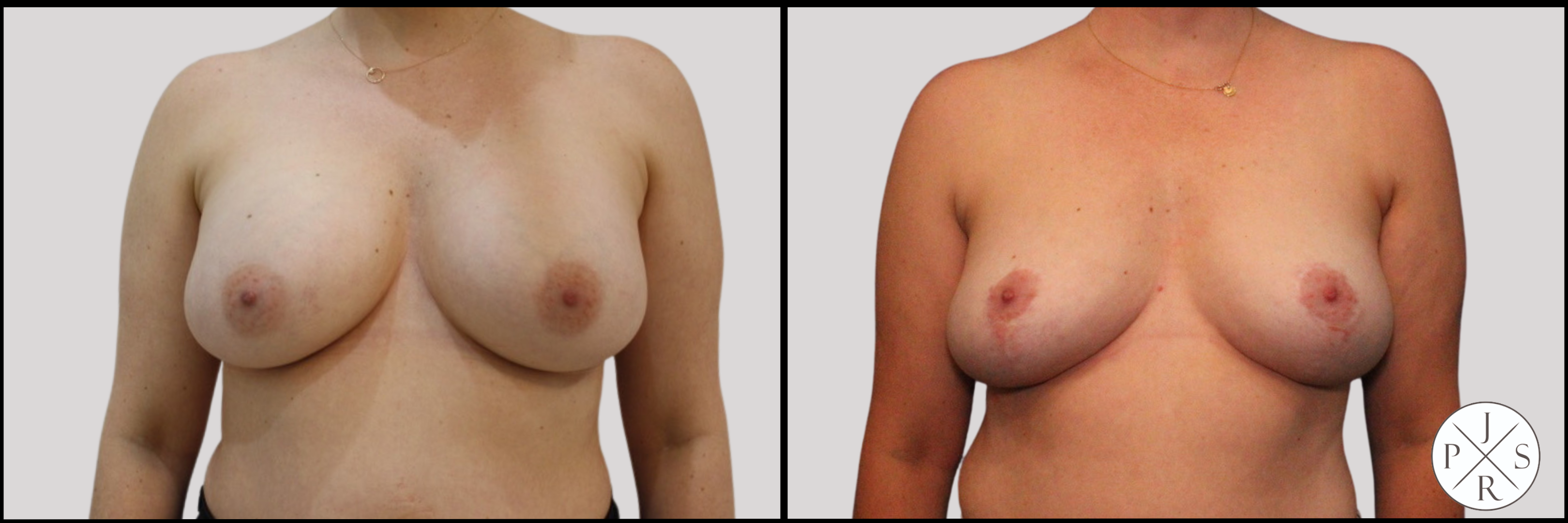 Breast Implant Removal Before & After Image